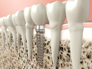 A very high 3D resolution illustration of a dental implant.