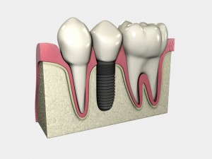 Dental implants require oral hygiene to maintain oral strength and health. 