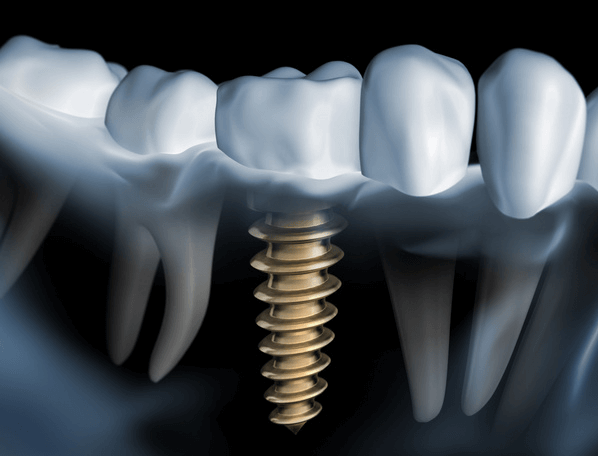 Dental Implants