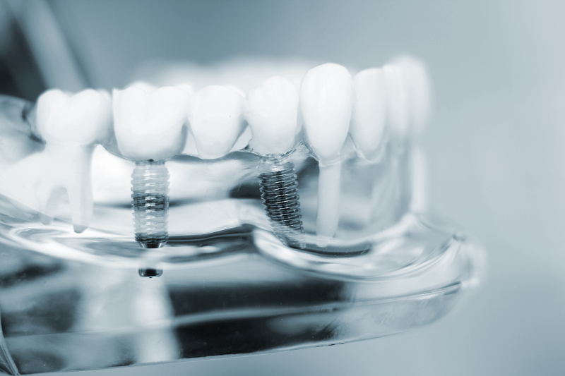 Dental implant