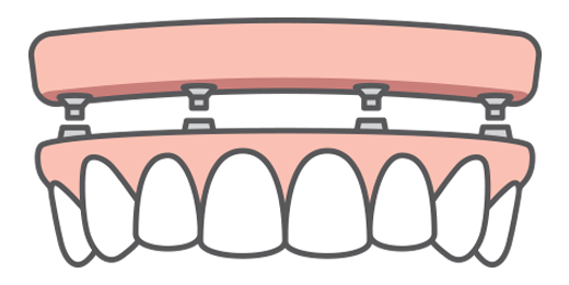 Illustration of an All-on-4 full-arch dental implant-supported bridge and how it fits onto four dental implants